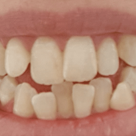 Toothfairy - Crowding