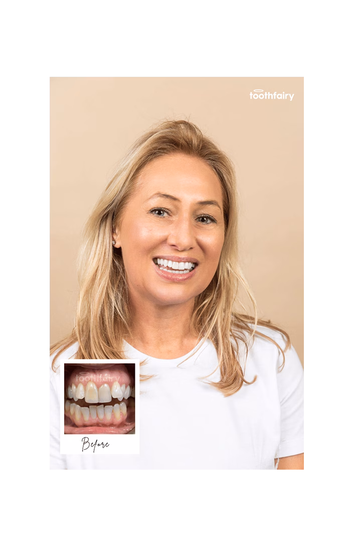 Toothfairy - Straighten then Whiten